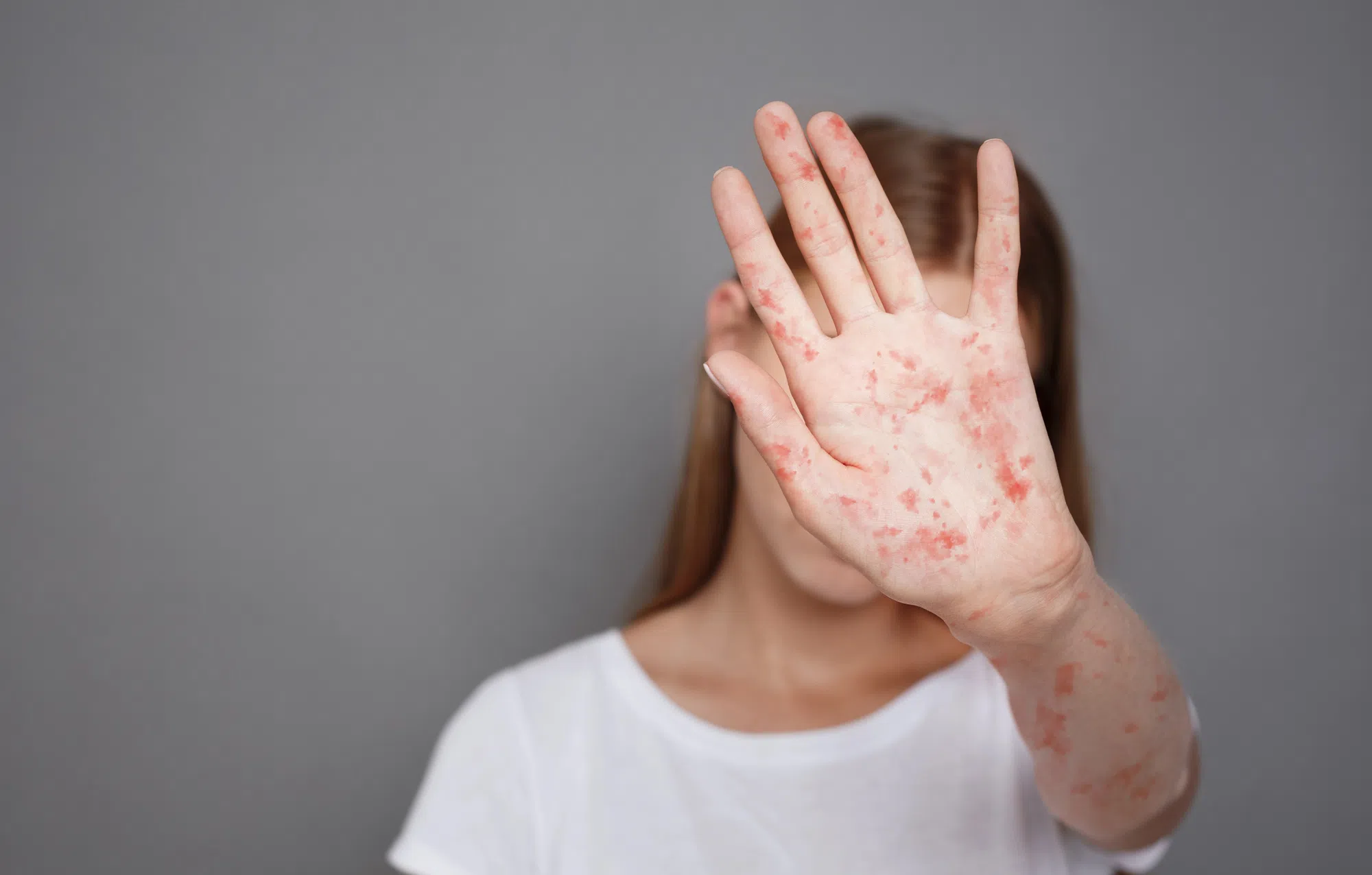Three new locations in Kamloops identified as measles exposure sites through second infection