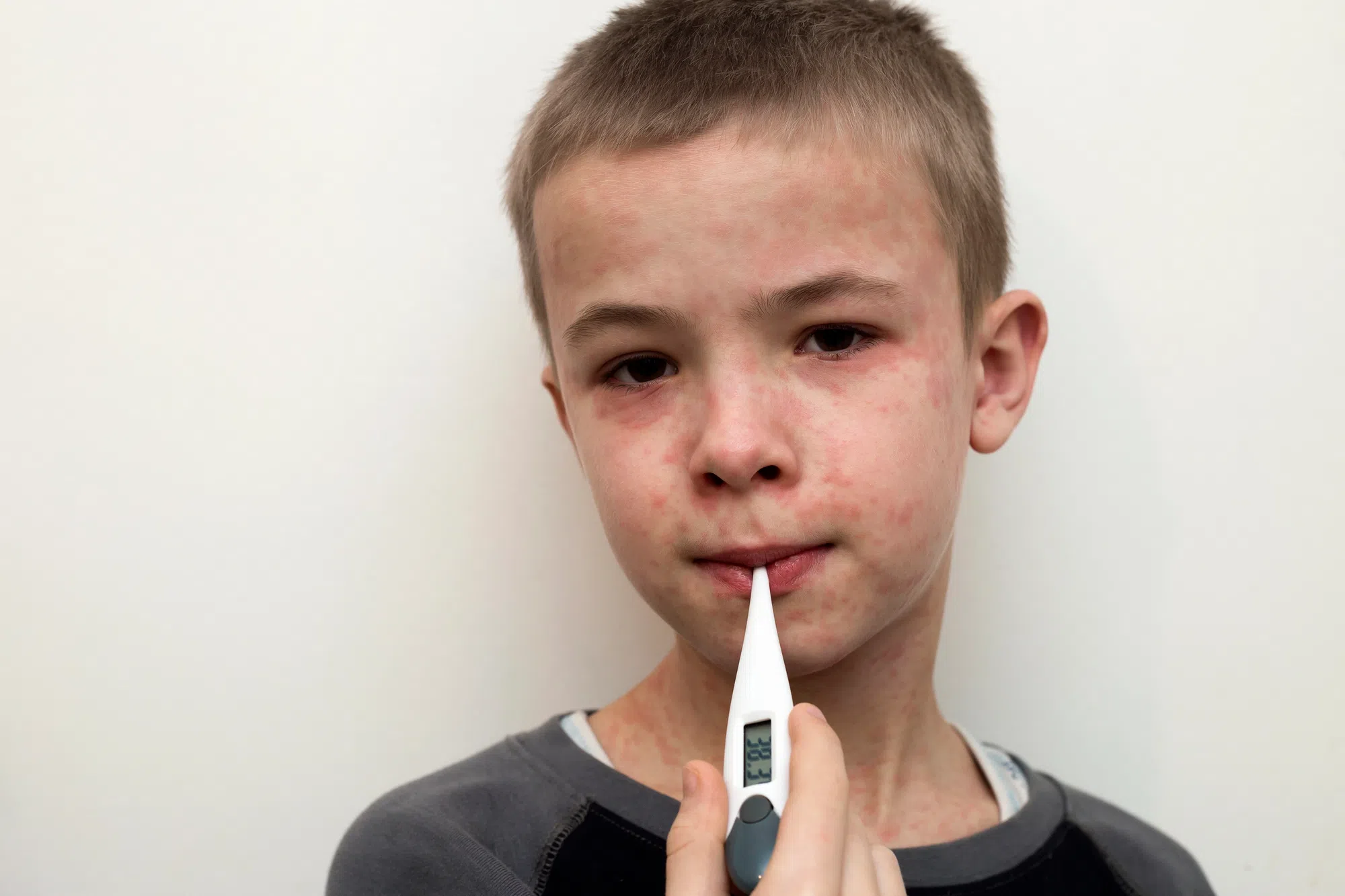 Measles arrives in Kamloops; Health Authority warns of possible exposures last week