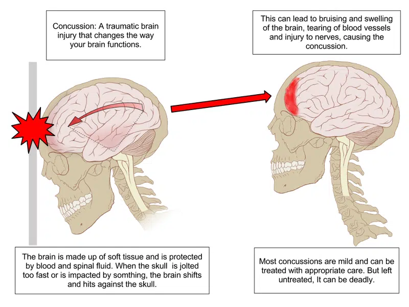 Ken Dryden Says Concussions Are The "Smoking Gun" Of Sports