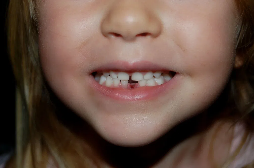 Lost A Tooth?  Looks Like You Are In The $$