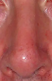 Why Does My Nose Itch?