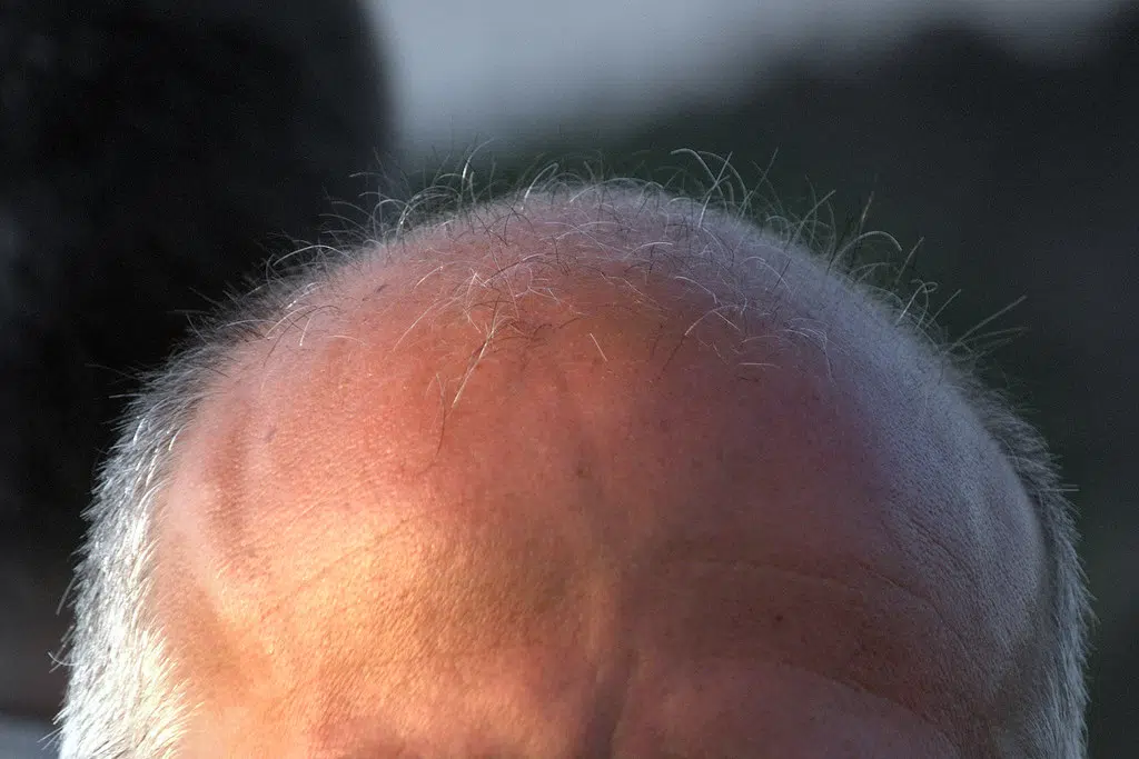 New Dating App For Bald People Aims To Help Destigmatize Hair Loss