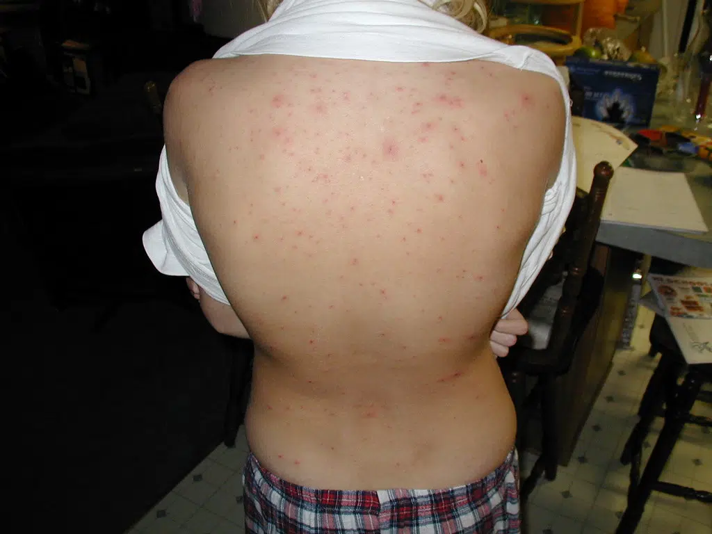 Chickenpox discovered at Loyalist College