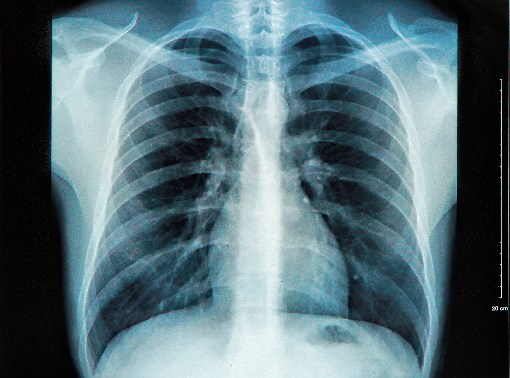 Mobile x-ray unit coming to Hastings Manor