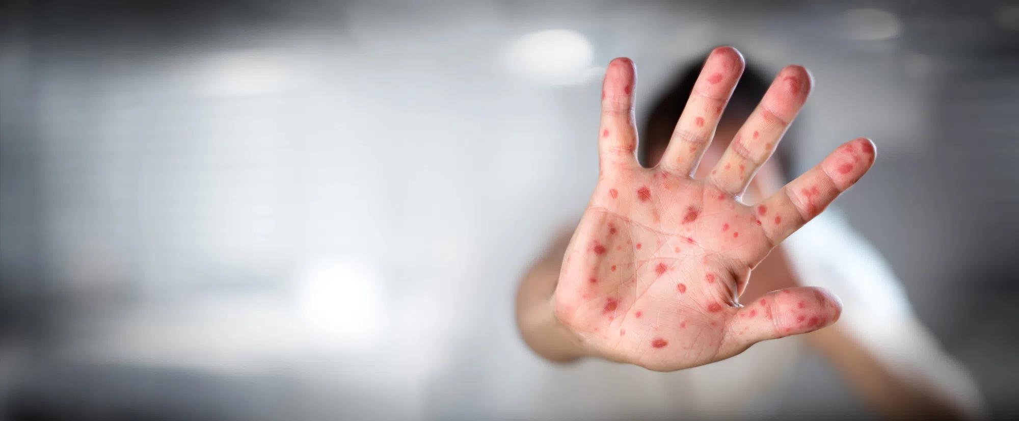 Measles exposure linked to nearby hospital