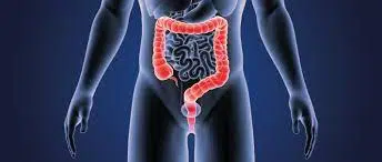 AWS: Colorectal cancer among people under 55 increases at an alarming rate