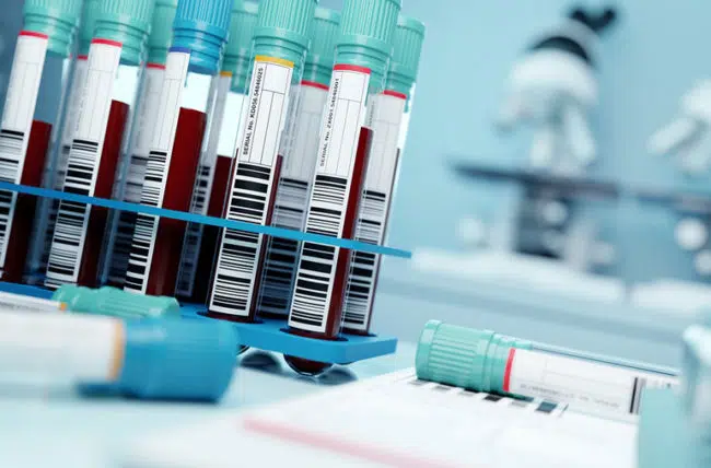 A new blood test detects early signs of cancer without symptoms