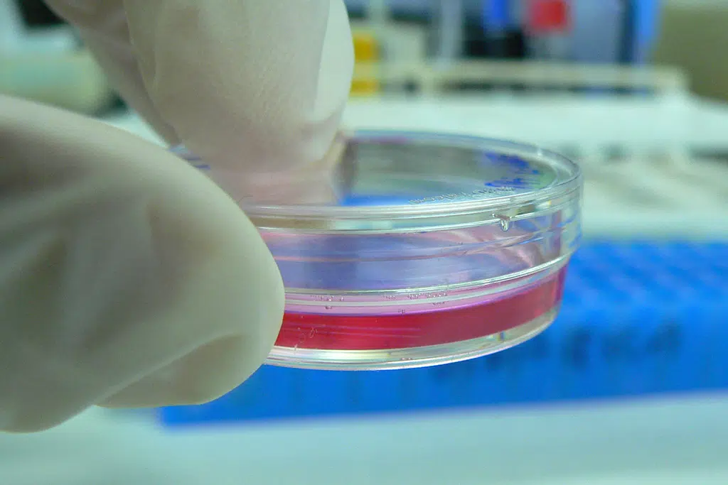 A rapidly spreading fungus is alarming the medical community
