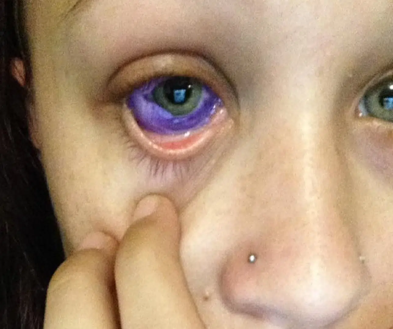 Eyeball tattooing: Calls for ban as procedure regulated in New South Wales  - ABC News