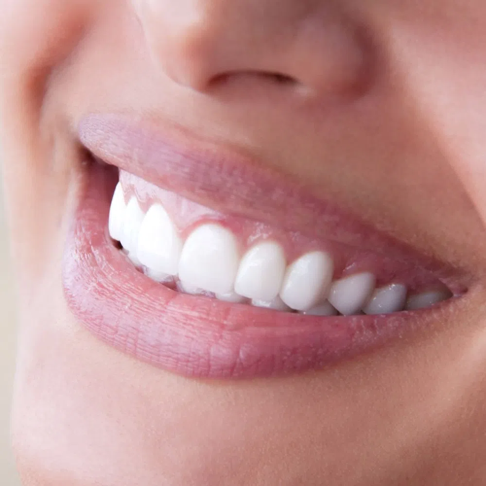 Important Pieces of Information About Veneers