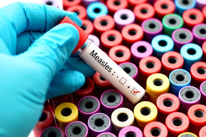 Some Schools Canceled Band Trip to Williston Because of Measles Cases