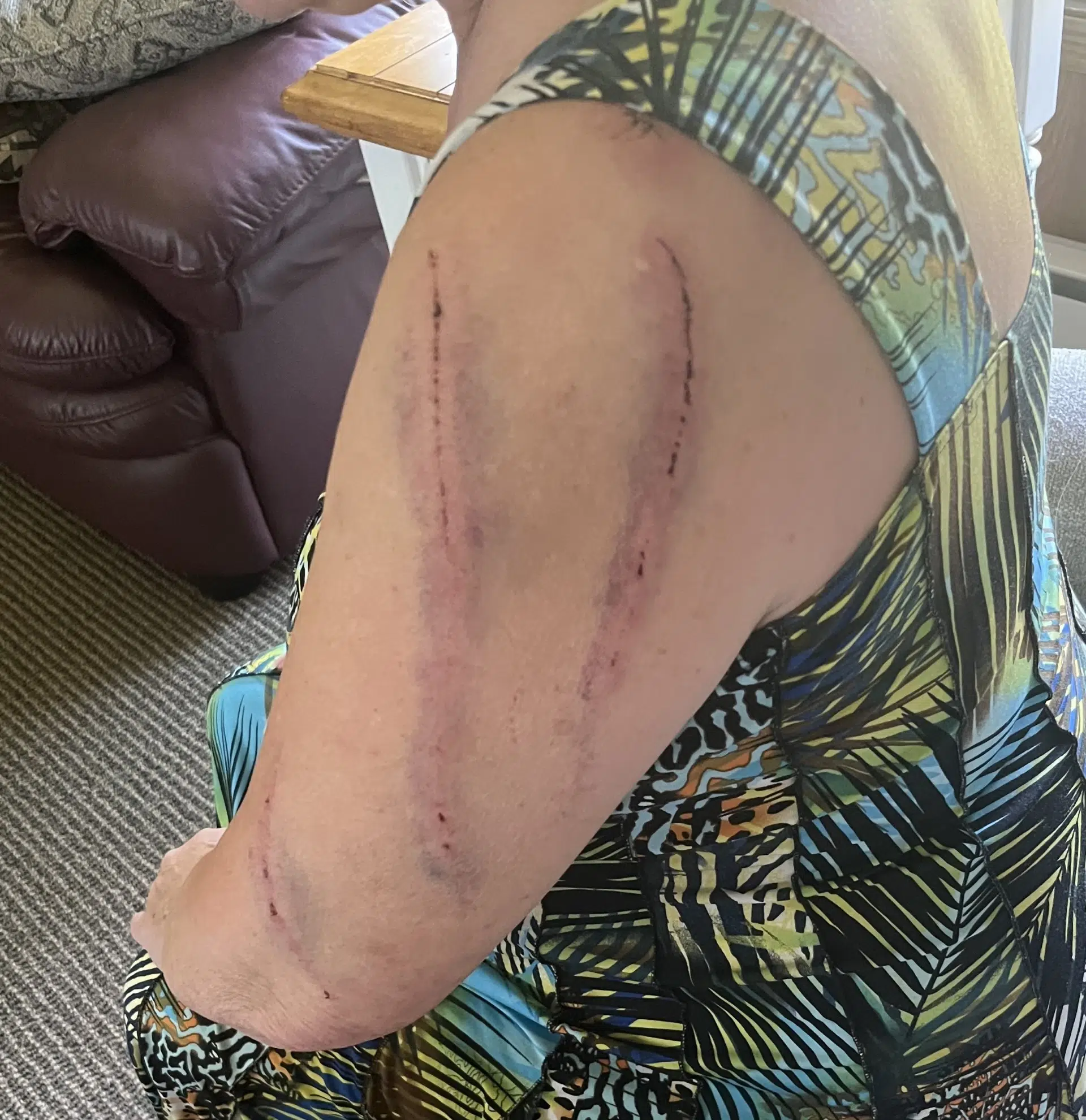 Minneapolis woman on the mend following bear attack near Nisswa | Lakes  Area Radio, image size:1920x1981