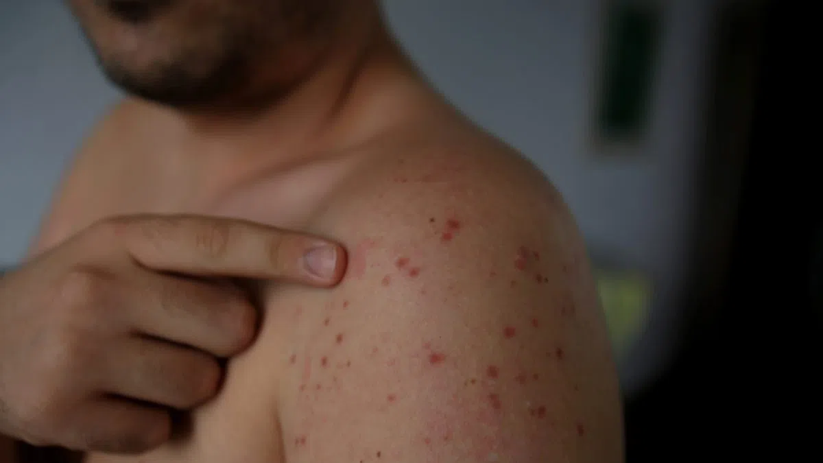 Measles case count jumps to 19 in North Dakota