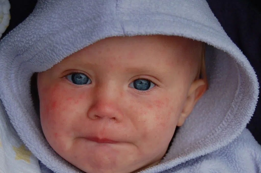 Nova Scotia measles outbreak grows to 30 cases, mostly among unvaccinated youth