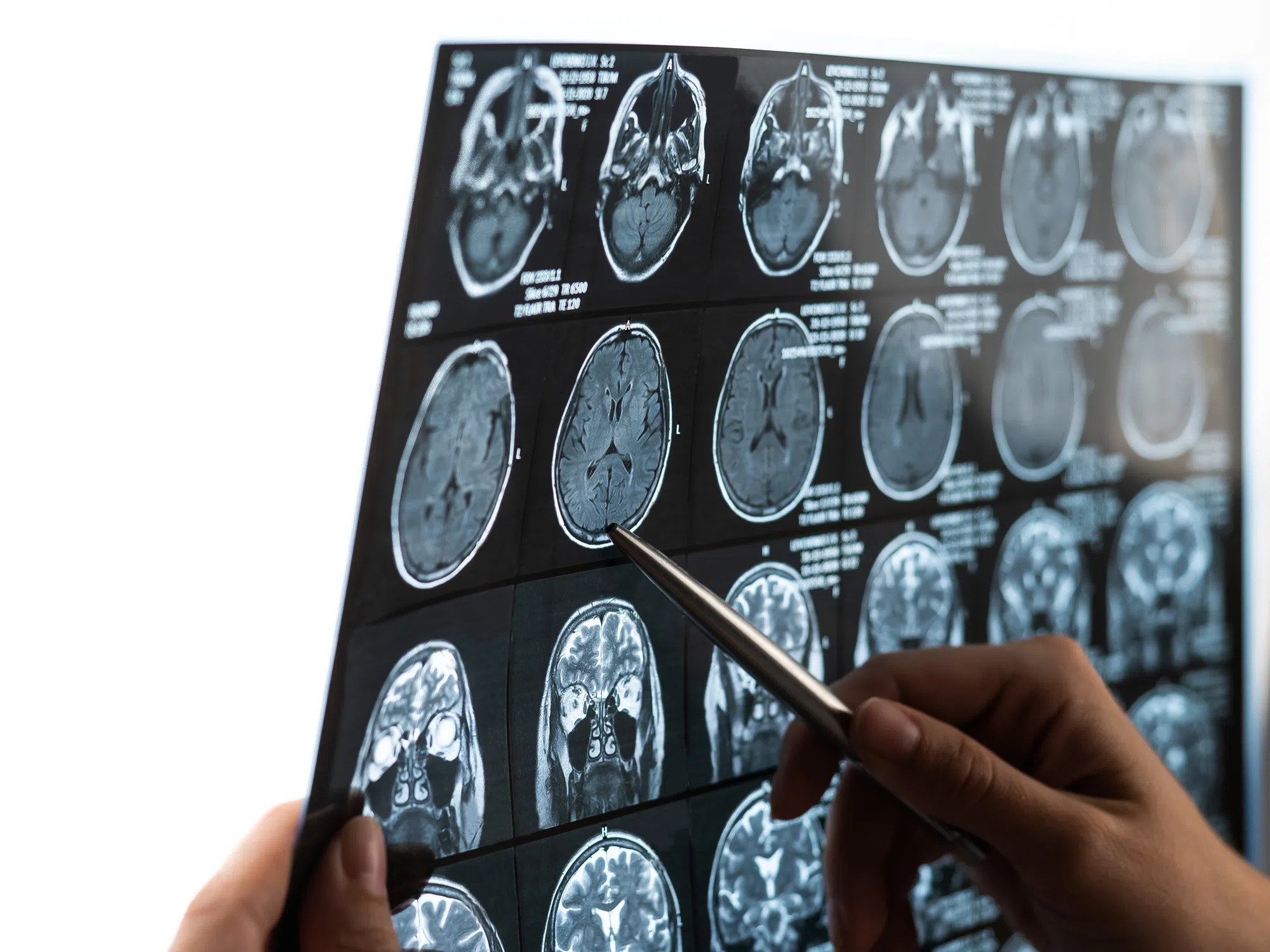 Mystery brain disease: Initial analysis complete, review underway