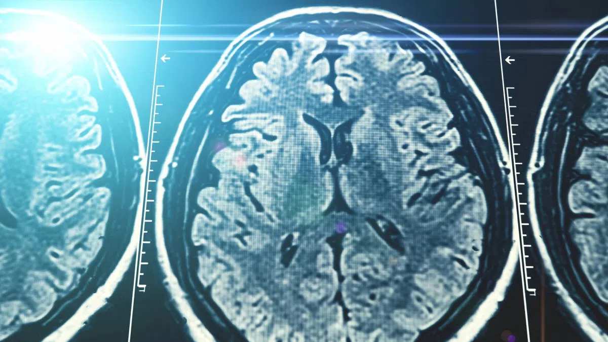 Stigma keeps many Canadians from seeking dementia help