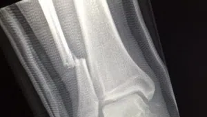 foo leg