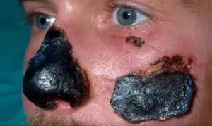 Face Frostbite
