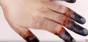 Hand Frostbite