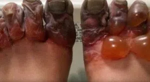 Toes Frostbite