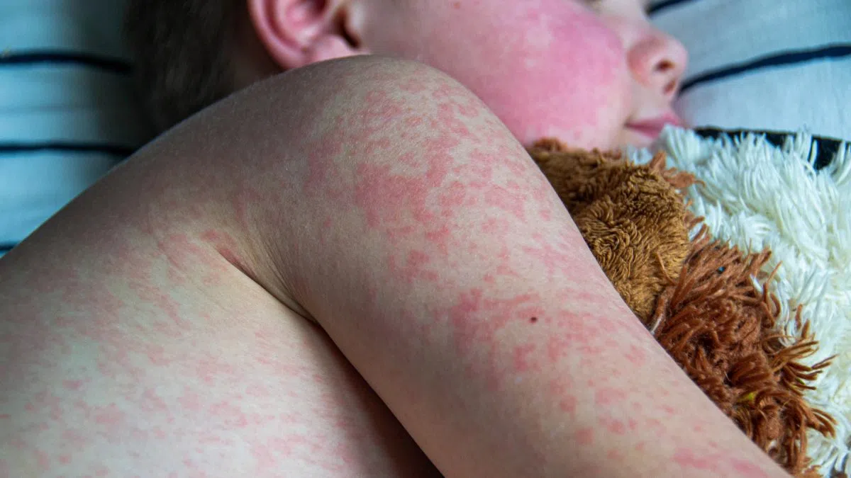 Second Canadian measles death this year reported in Alberta