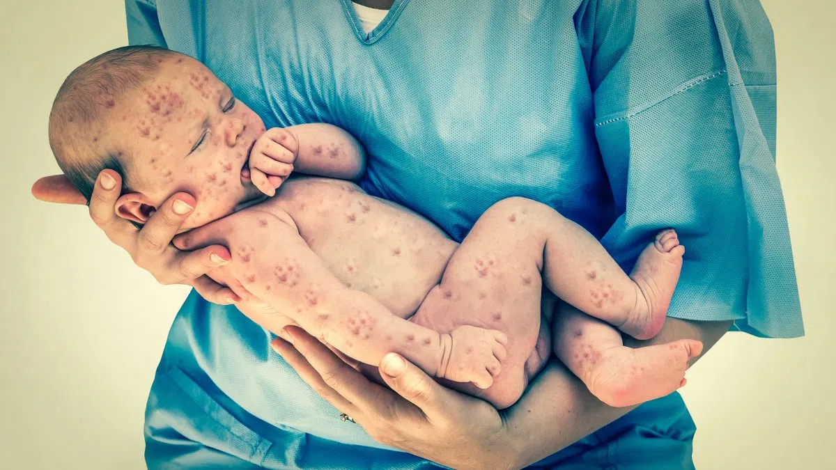 Alberta's Measles Outbreak Now Rivals Entire U.S. - Health Officials Urged to Act