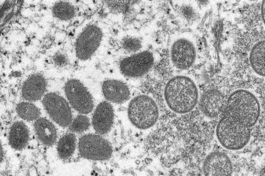 Saskatchewan gov't reports second case of monkeypox