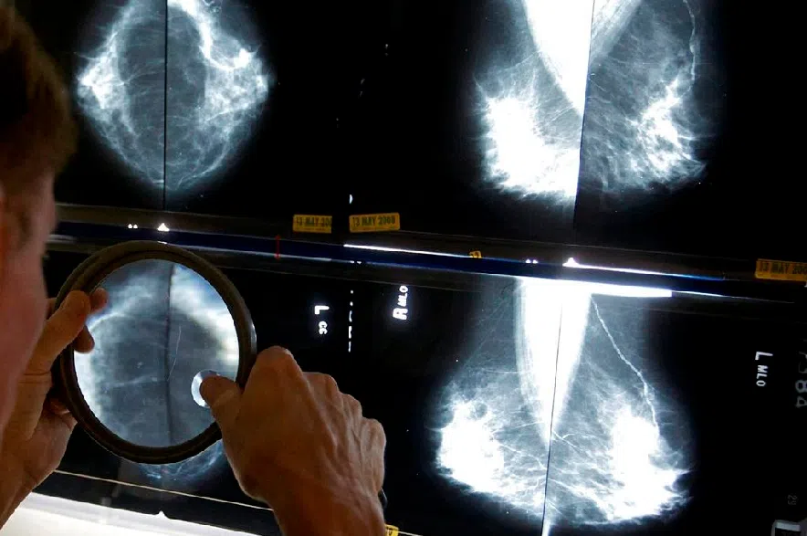 Breast cancer screening should start at age 40, Canadian Cancer Society says