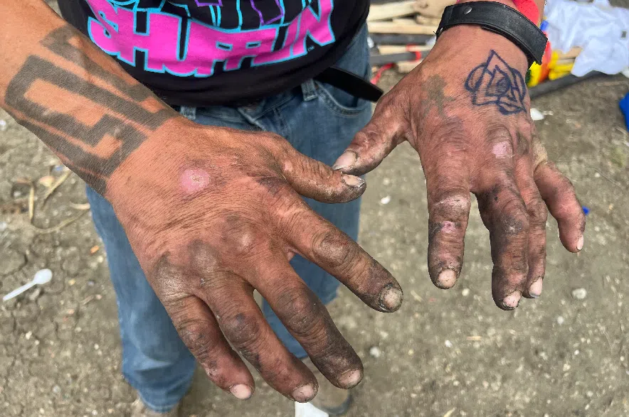 Ron D.W.B. said it is really hard living outside, explaining that many homeless people have sores on their hands from the conditions.