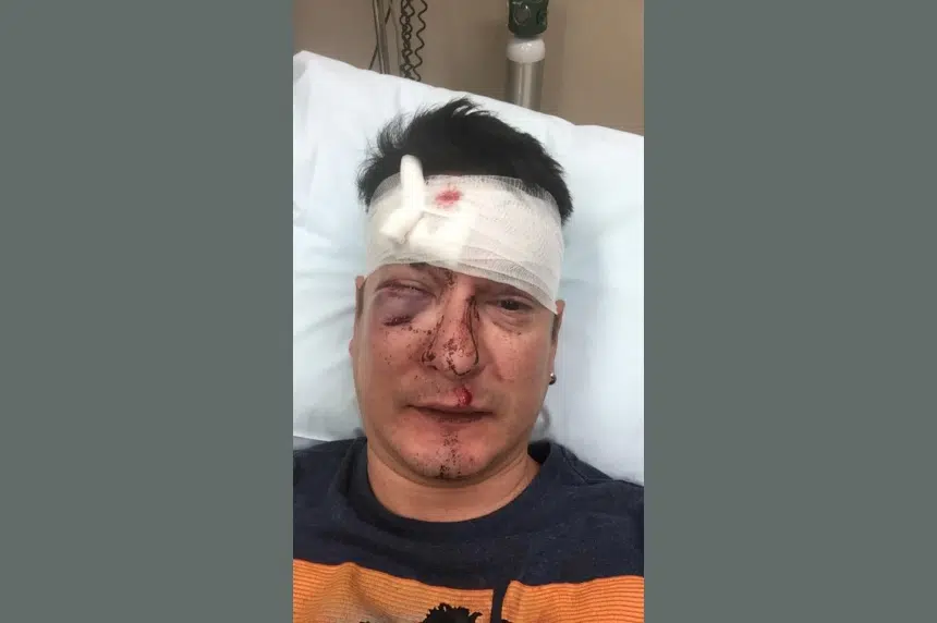 Beaten, but not defeated: Gay Saskatoon man posts photos of brutal bar attack