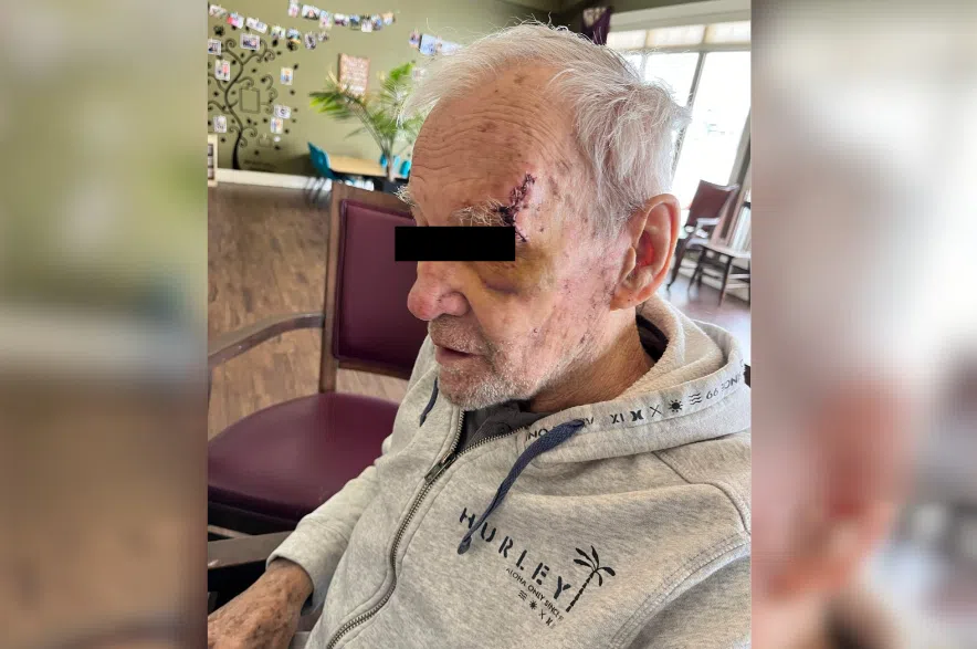The family of 92-year-old dementia resident, Barney, says he was attacked by another resident while living at Diamond House in Warman on Feb. 5, 2024. 650 CKOM is withholding his last name and facial features to respect his privacy.
