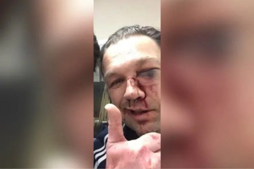 Chris Relitz shows his injuries.