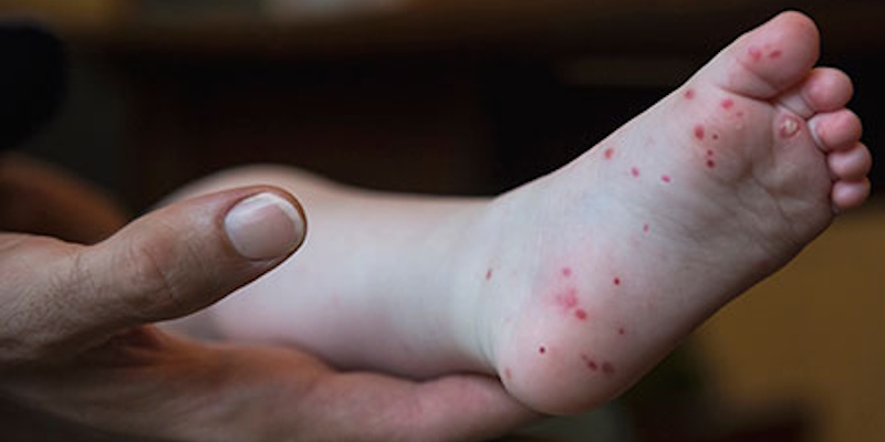 Province Not Keeping Track of Hand, Foot and Mouth Cases